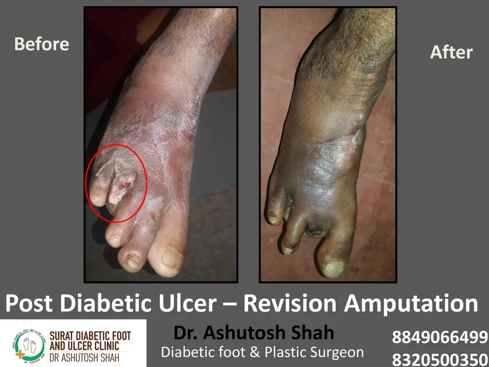 Diabetic Foot  PPT 3 checked by sir.pptx-49.webp